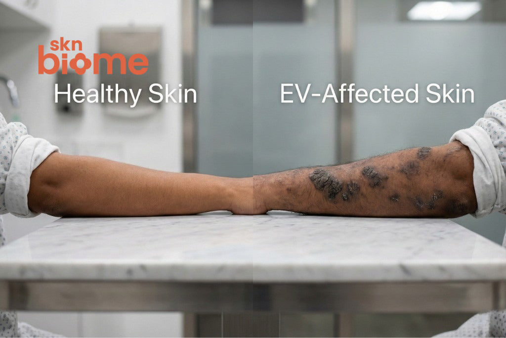 Epidermodysplasia verruciformis affected skin – dermatologist explains this rare HPV-linked skin condition | Skn Biome
