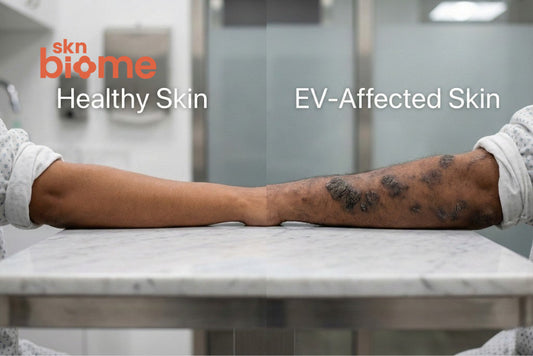 Epidermodysplasia Verruciformis (EV) in simple terms