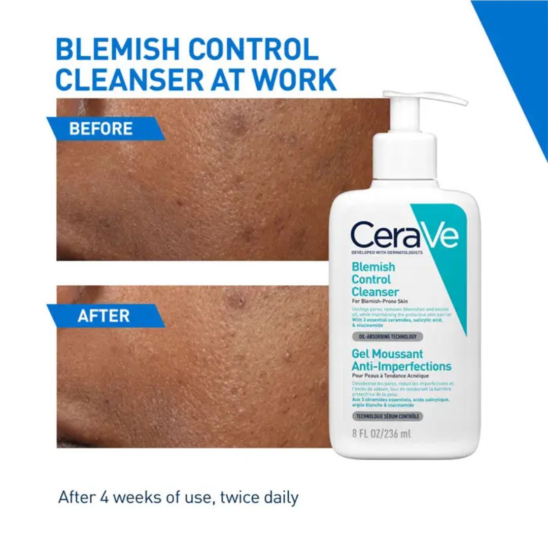 CeraVe Blemish Control Cleanser with Salicylic Acid for Acne – Skn Biome before after 